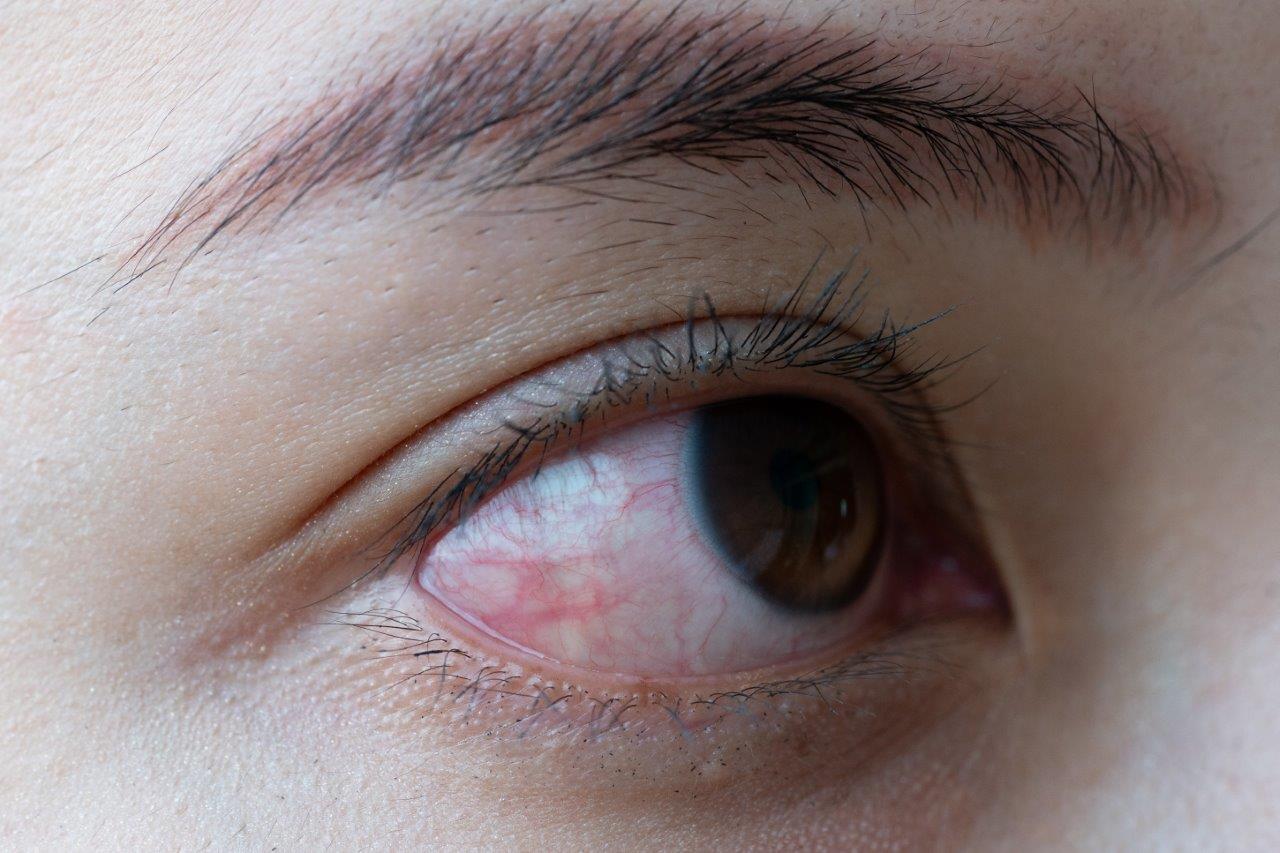 Woman's eye infected with conjunctivitis