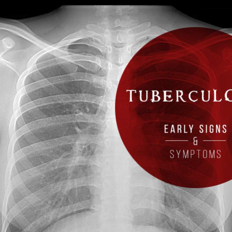 Tuberculosis: Early Signs and Symptoms