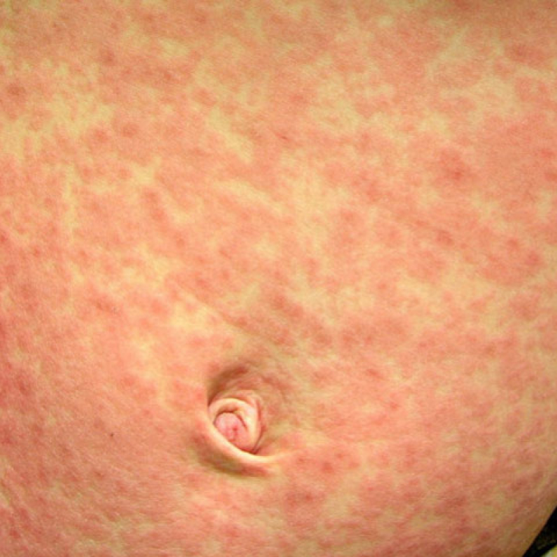 Roseola vs Measles: What’s the Difference?