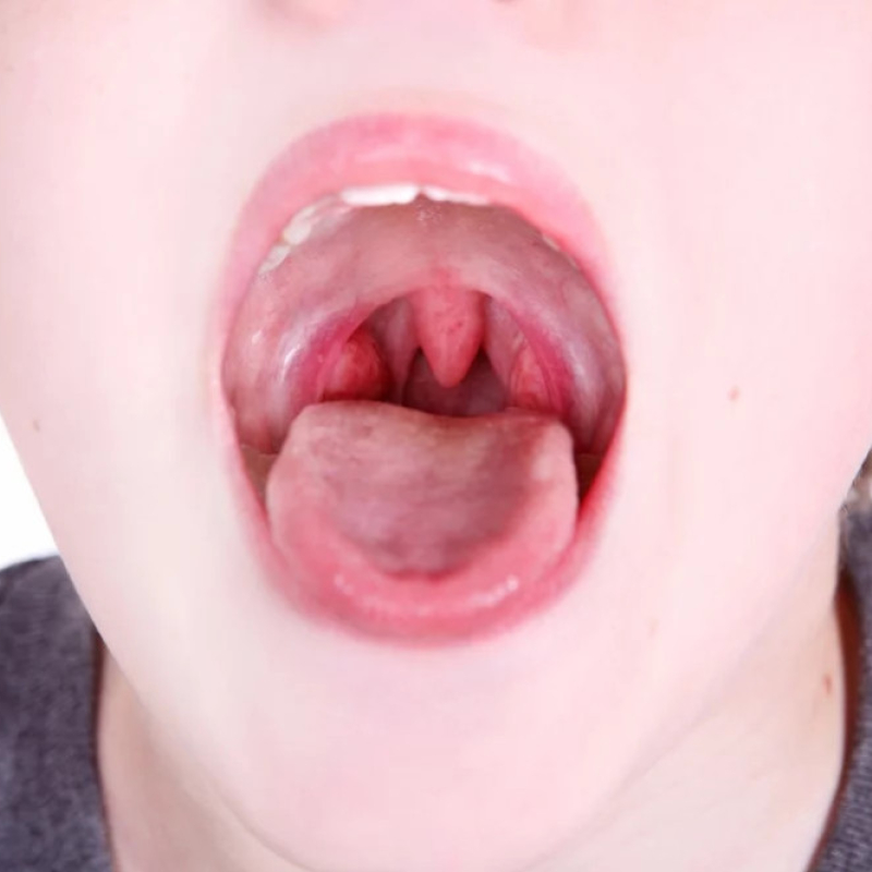 Help! What’s the Difference Between a Sore Throat and Tonsillitis?