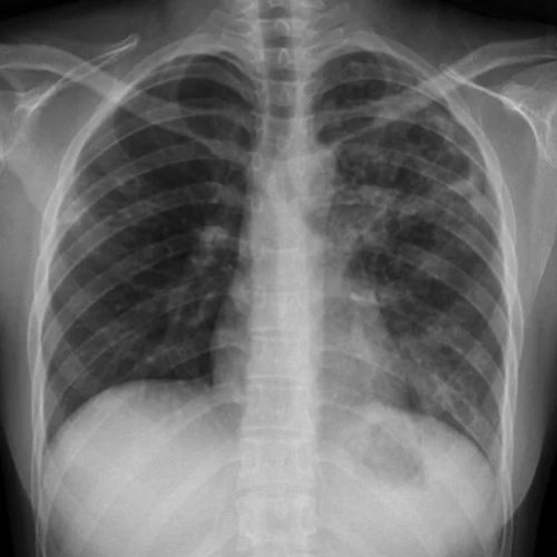 Tuberculosis: causes, symptoms, and medication