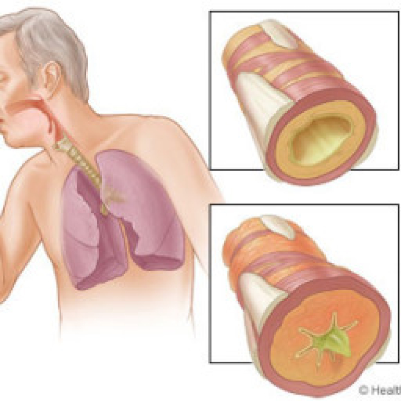 I Was Diagnosed With Bronchitis? What Is It? And What Do I Do?